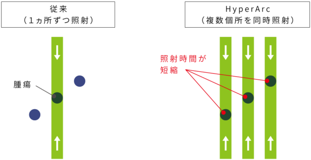 多発脳転移に対する定位放射線治療（HyperArc）