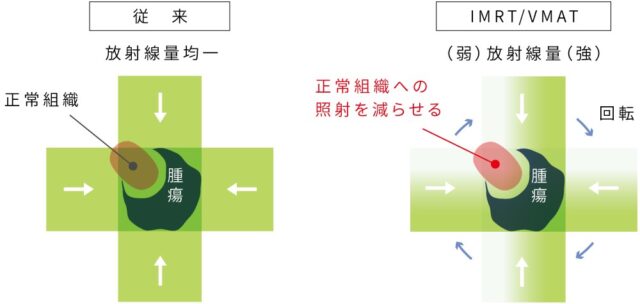 腫瘍の形に合わせて放射線量を調節する強度変調放射線治療（IMRT）・回転IMRT（VMAT）