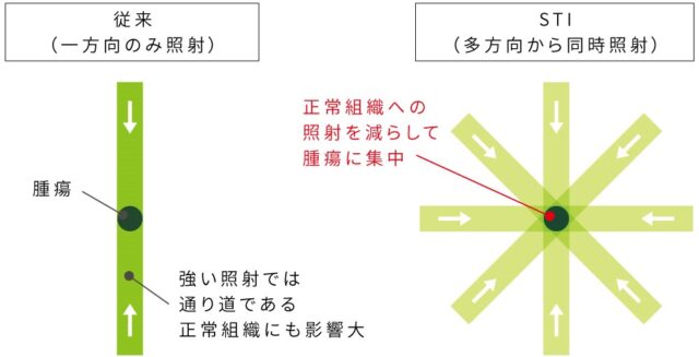 小さな腫瘍に多方面からピンポイントに集中照射　定位放射線照射（STI）